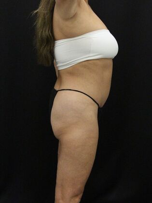 Tummy Tuck: Case 40 - After