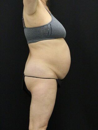 Tummy Tuck: Case 40 - Before