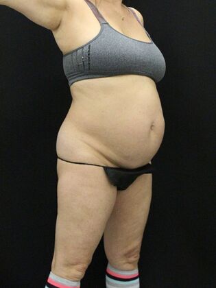 Tummy Tuck: Case 40 - Before