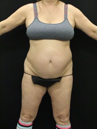 Tummy Tuck Case 40 - Before