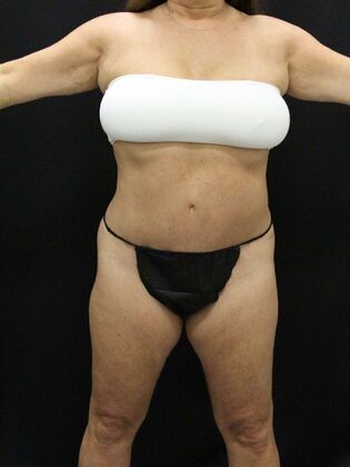 Tummy Tuck Case 40 - After