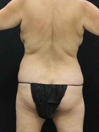Liposuction Case 36 - Before