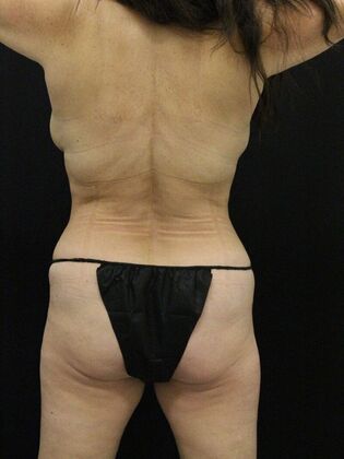 Liposuction Case 36 - After