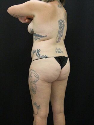 Liposuction: Case 37 - Before