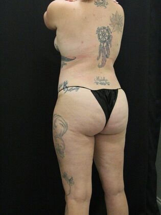 Liposuction: Case 37 - After
