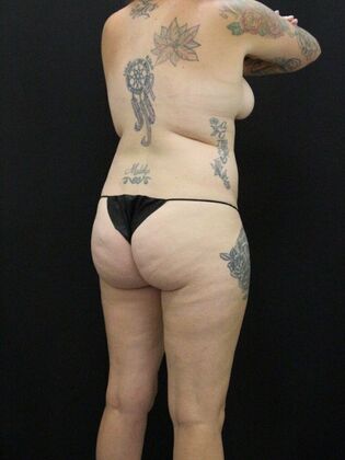 Liposuction: Case 37 - Before