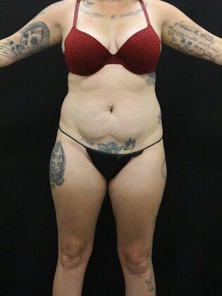 Tummy Tuck Case 41 - Before