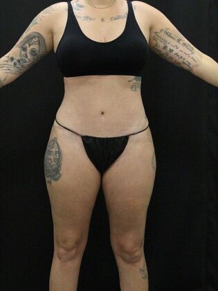 Tummy Tuck Case 41 - After