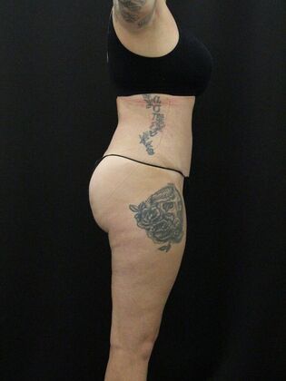 Tummy Tuck: Case 41 - After