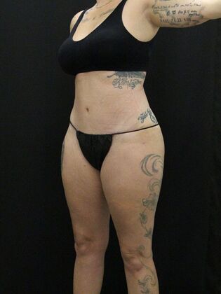 Tummy Tuck: Case 41 - After