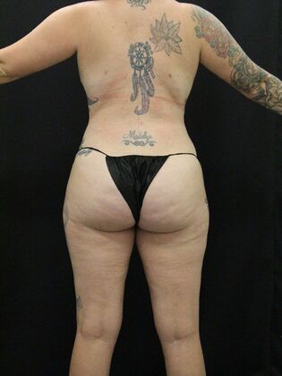 Tummy Tuck: Case 41 - After