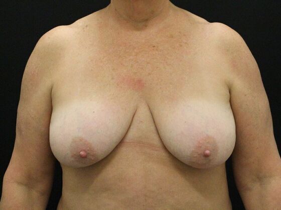 Breast Reduction & Lift Case 19 - Before