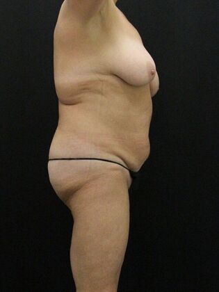 Tummy Tuck: Case 42 - Before