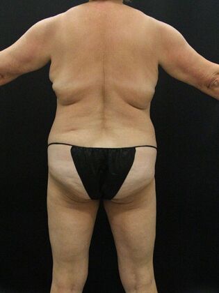 Tummy Tuck: Case 42 - Before