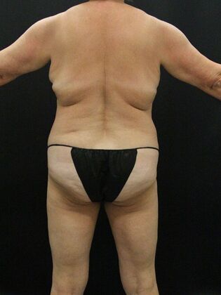 Liposuction Case 38 - Before