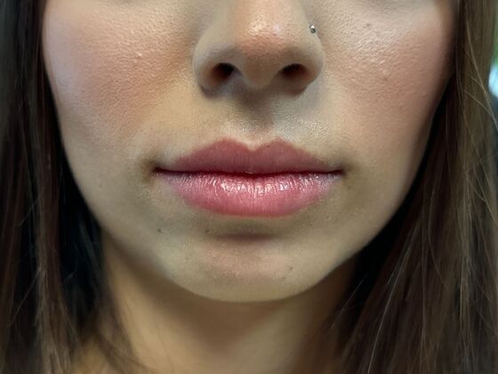 Cosmetic Injectables & Fillers*: Case 60 Lip Filler - Before