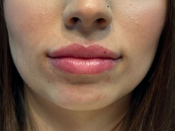 Cosmetic Injectables & Fillers*: Case 60 Lip Filler - After