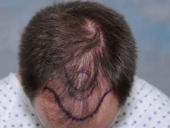 FUT Hair Restoration Case 43 - Before