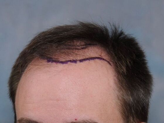 FUT Hair Restoration: Case 43 - Before