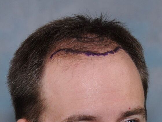 FUT Hair Restoration: Case 43 - Before