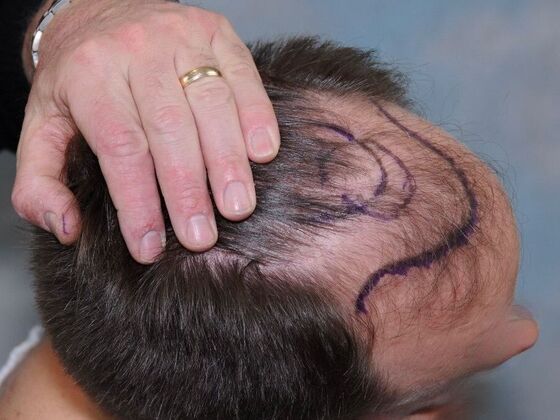 FUT Hair Restoration: Case 43 - Before