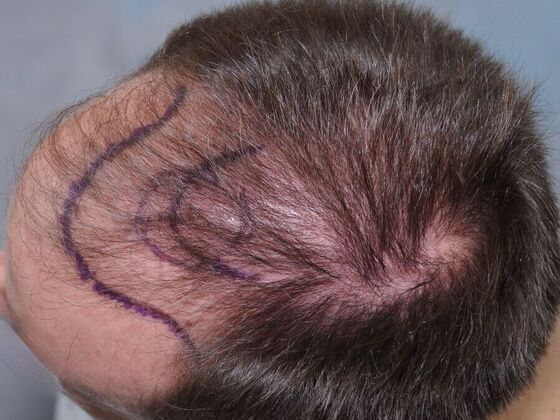 FUT Hair Restoration: Case 43 - Before