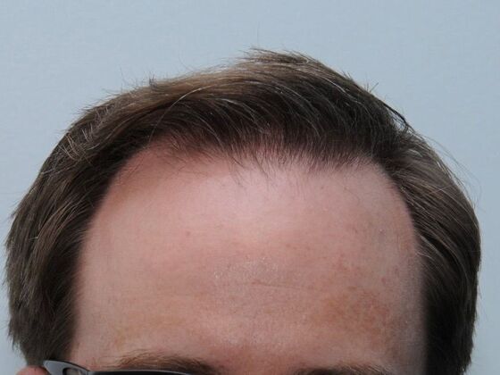 FUT Hair Restoration: Case 43 - Before