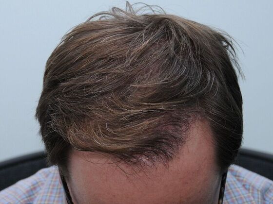 FUT Hair Restoration Case 43 - After