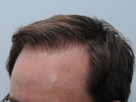 FUT Hair Restoration: Case 43 - After