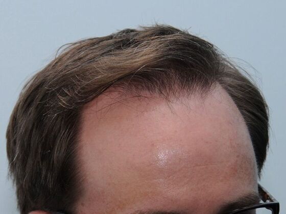 FUT Hair Restoration: Case 43 - After