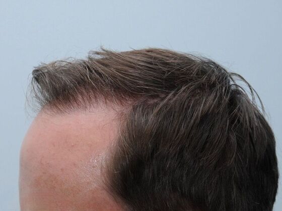 FUT Hair Restoration: Case 43 - After