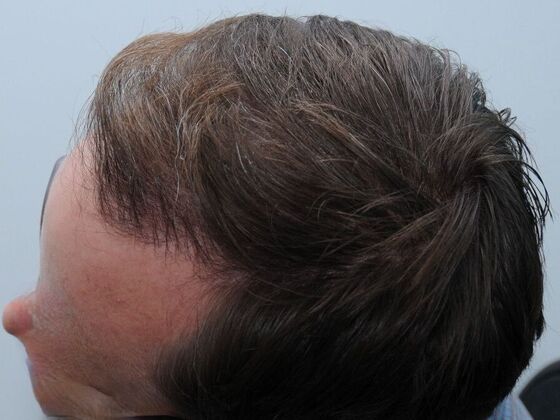 FUT Hair Restoration: Case 43 - After