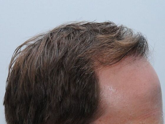 FUT Hair Restoration: Case 43 - After