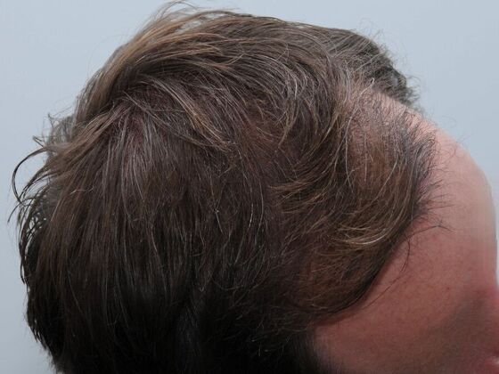 FUT Hair Restoration: Case 43 - After