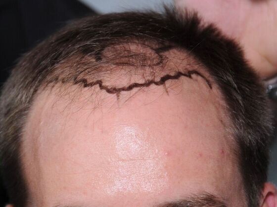 FUT Hair Restoration: Case 43 - After