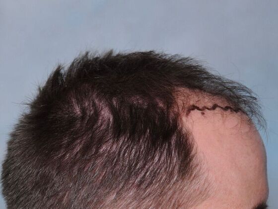 FUT Hair Restoration: Case 43 - Before