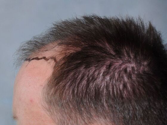 FUT Hair Restoration: Case 43 - Before