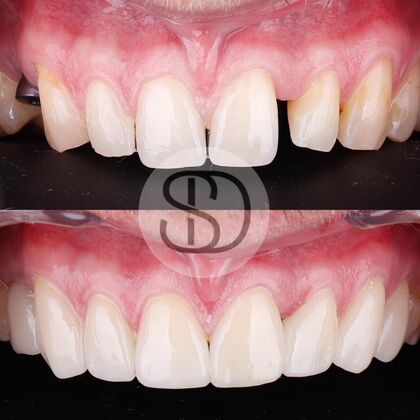 Veneers Blake, 33, Veneers