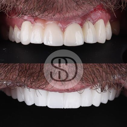 Full Mouth Restoration with Zirconia Crowns Case 2