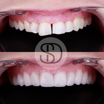 Full Mouth Restoration with Zirconia Crowns Case 9
