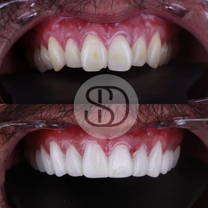 Full Mouth Restoration with Zirconia Crowns Case 10