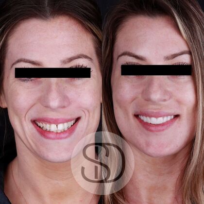 Full Mouth Restoration with Zirconia Crowns Case 11