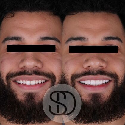 Veneers Ismael-28-Veneers