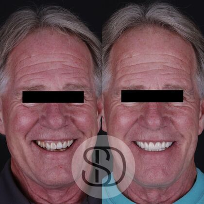 Full Mouth Restoration with Zirconia Crowns Case 12