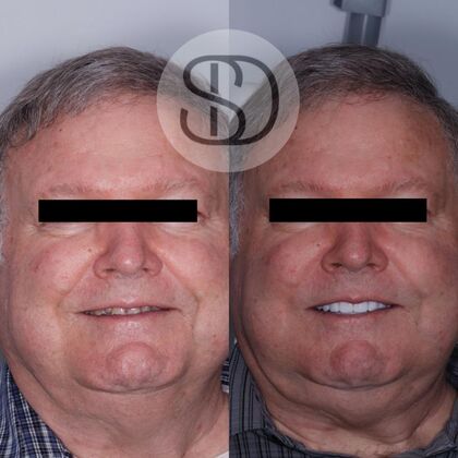 Full Mouth Restoration with Zirconia Crowns Case 13