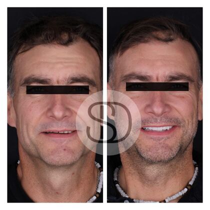 Veneers Tim, 49, Veneers