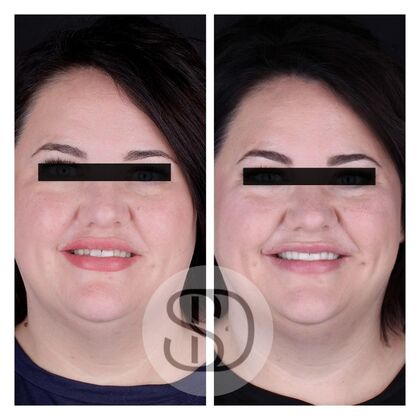 Full Mouth Restoration with Zirconia Crowns Case 14