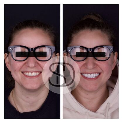 Full Mouth Restoration with Zirconia Crowns Case 16