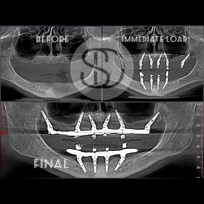 All-on-X Proper placement of implants for an All-On-X