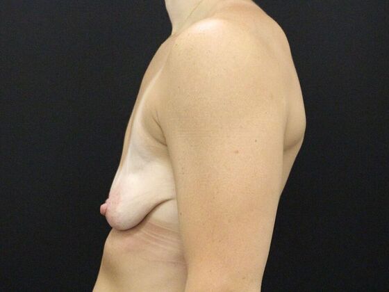 Breast Lift/Breast Lift Augmentation: Case 54 - Before